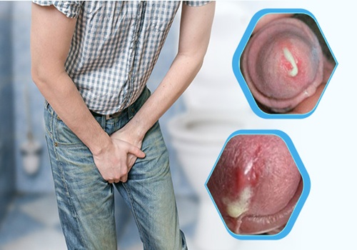 Tiểu rát ra mủ ở nam giới cảnh báo bệnh lý nguy hiểm nào?