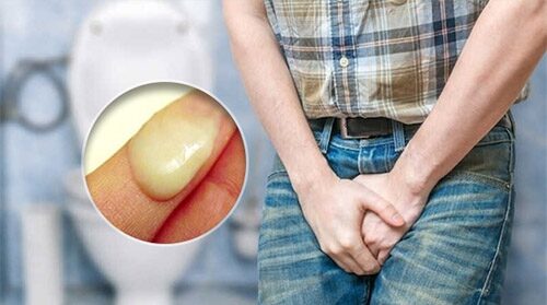 Đi tiểu buốt có mủ ở nam giới cảnh báo bệnh gì?