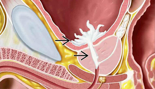 Xuất tinh ngược gây nguy cơ vô sinh cao ở nam giới