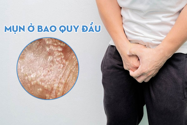 Triệu chứng nổi mụn ở bao quy đầu là bị gì?