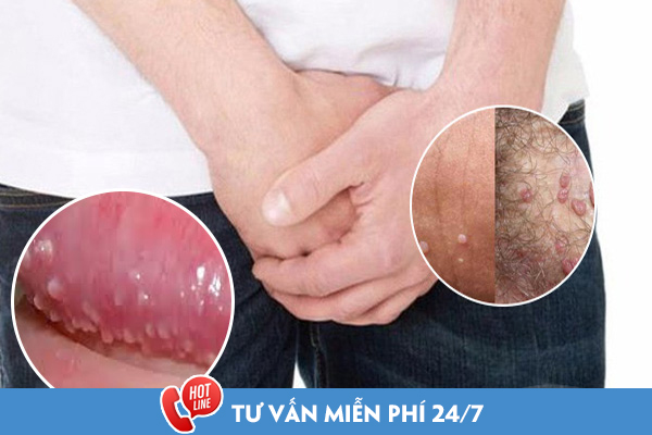 Nguyên nhân gây mụn bao quy đầu là do đâu?
