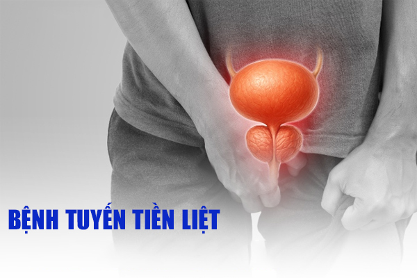 3 bệnh tuyến tiền liệt thường gặp ở nam giới