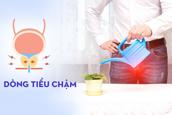 Nguyên nhân và cách chữa dòng tiểu chậm ở nam