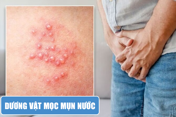 Cậu nhỏ mọc mụn nước – Nguyên nhân và địa chỉ khám chữa hiệu quả
