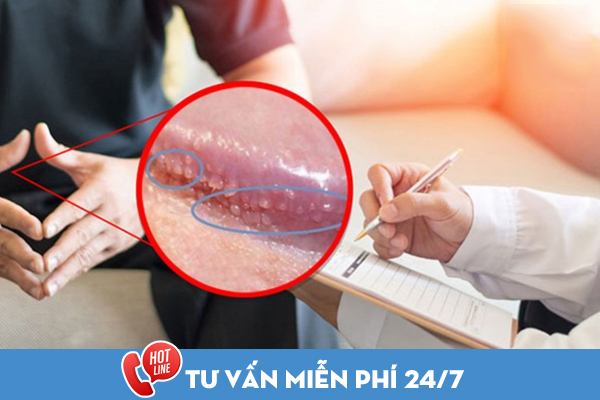 Cách điều trị chuỗi hạt ngọc dương vật hiện đại, hiệu quả nhanh