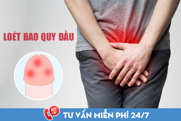 Bị loét bao quy đầu bôi thuốc gì nhanh khỏi? Cách chữa bệnh hiệu quả