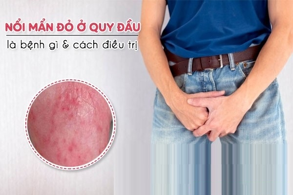 Nguyên nhân gây nổi mẩn bao quy đầu