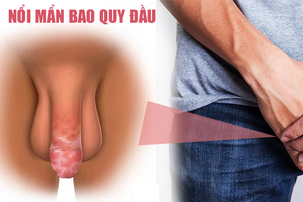 Triệu chứng nổi mẩn bao quy là bị gì? Có sao không?