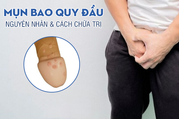 Bao quy đầu nổi mụn là bị gì? Cách xử lý an toàn và hiệu quả nhanh