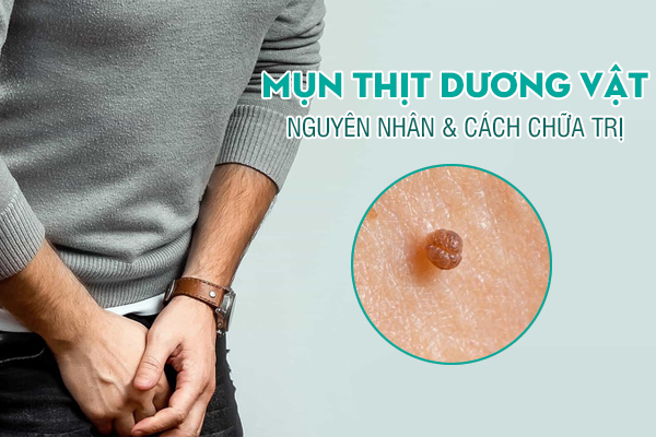 Mụn thịt ở dương vật là dấu hiệu cảnh báo bệnh gì? Điều trị như thế nào?