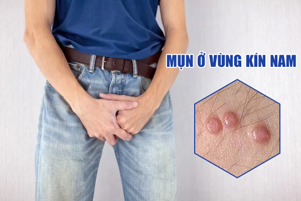Nổi mụn ở vùng kín nam là bị gì? Cách điều trị hiệu quả