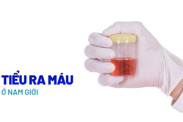 Các nguyên nhân gây tiểu ra máu ở nam giới và cách khắc phục