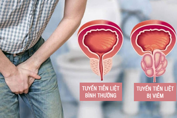 Viêm tuyến tiền liệt là bệnh gì? Nguyên nhân gây bệnh